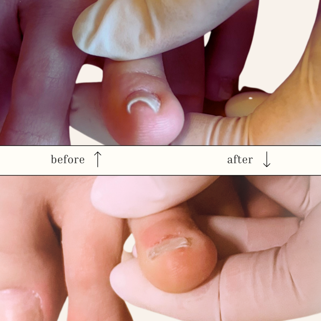 2趾の矯正事例